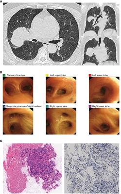 Efficacy of befotertinib in non-small cell lung cancer harboring uncommon compound EGFR mutations G719X and S768I: a case report